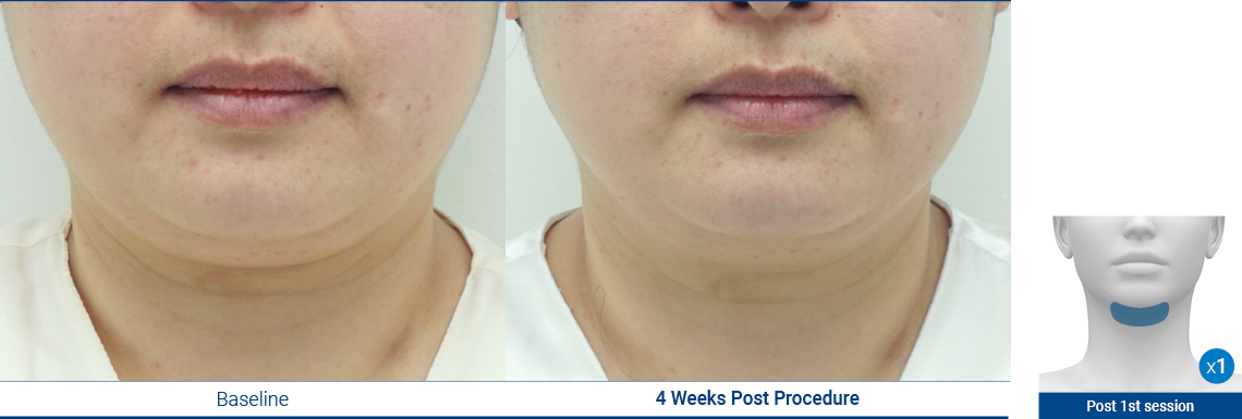 DoubleChin_190103_Proven-Results_1