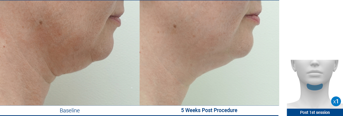 DoubleChin_190103_Proven-Results_2 (1)